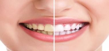 5 Cara Memutihkan Kembali Gigi Kuning dengan Efektif